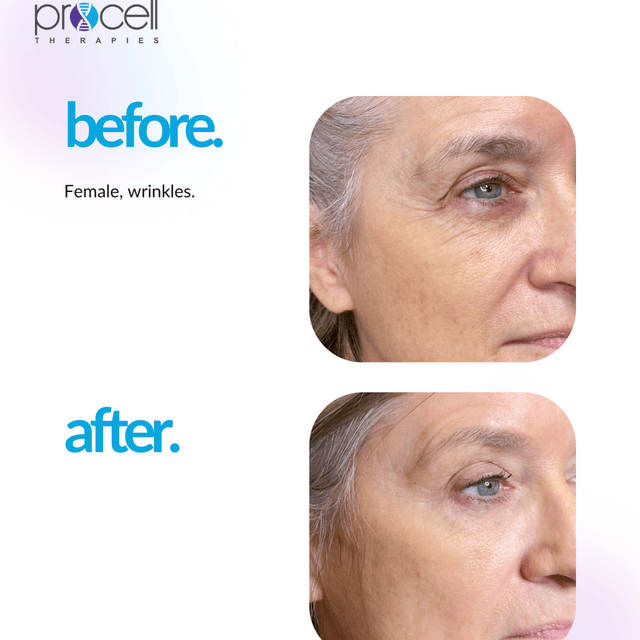 Procell Microchanneling Full Face at Livi Facial & Beauty Spa in Conway, AR