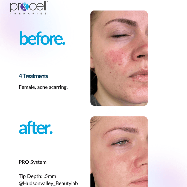 Procell Microchannel: Face & Neck at Livi Facial & Beauty Spa in Conway, AR