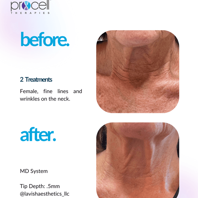 Procell Microchanneling(6)FullFace at Livi Facial & Beauty Spa in Conway, AR